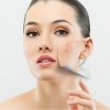 ����������� ������� (Azelaic acid)