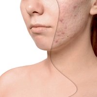 Acneol� (������, ����-���� ��������)